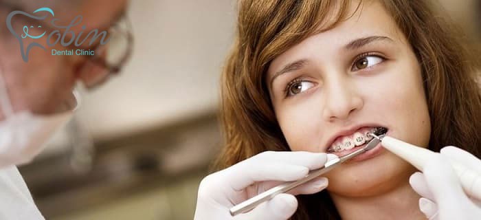 جای نگرانی برای لق شدن دندان ها در طول ارتودنسی وجود ندارد.